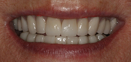 Case Three after smile enhancement